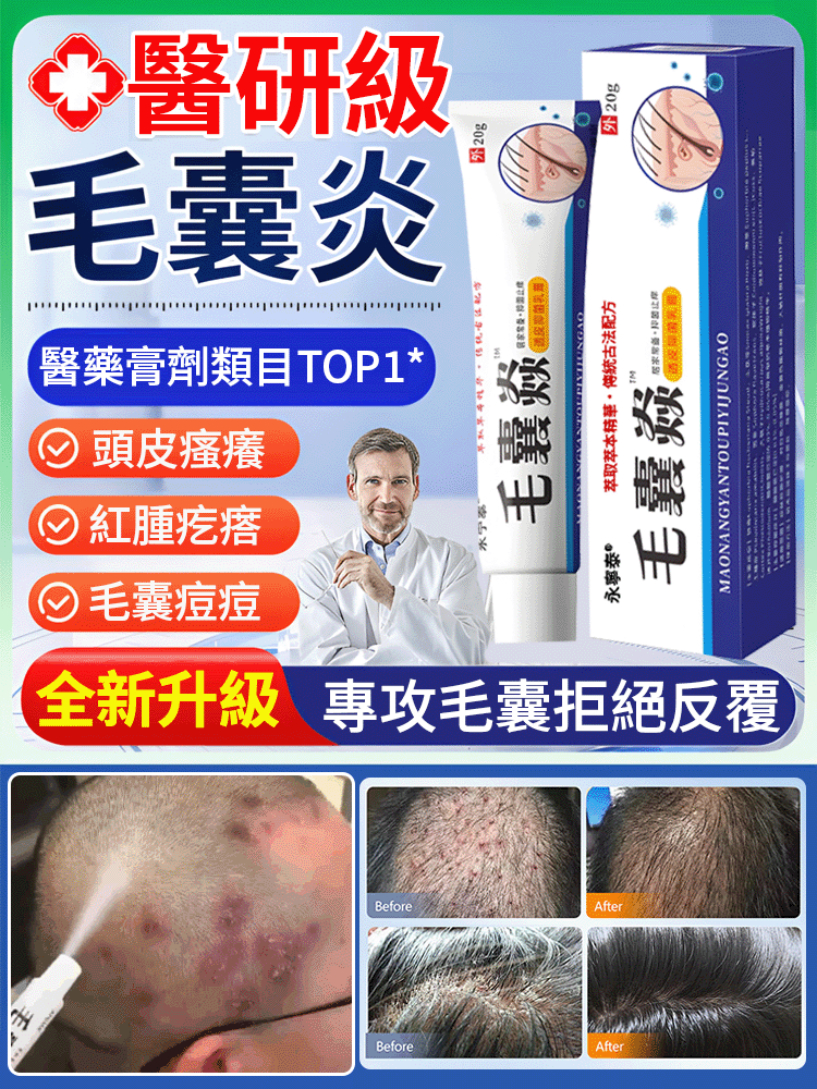 【一抹消痘！3天治愈毛囊炎】膿包？痘痘？紅疹？頭部？背部？手部？毛囊淨，專攻各種毛囊炎，草本無副作用！